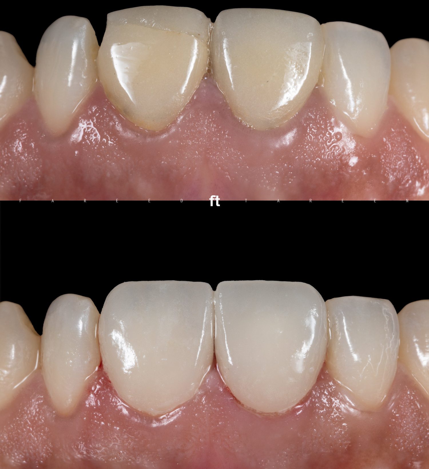 Central Dominance — milled lithium disilicate crowns, before and after