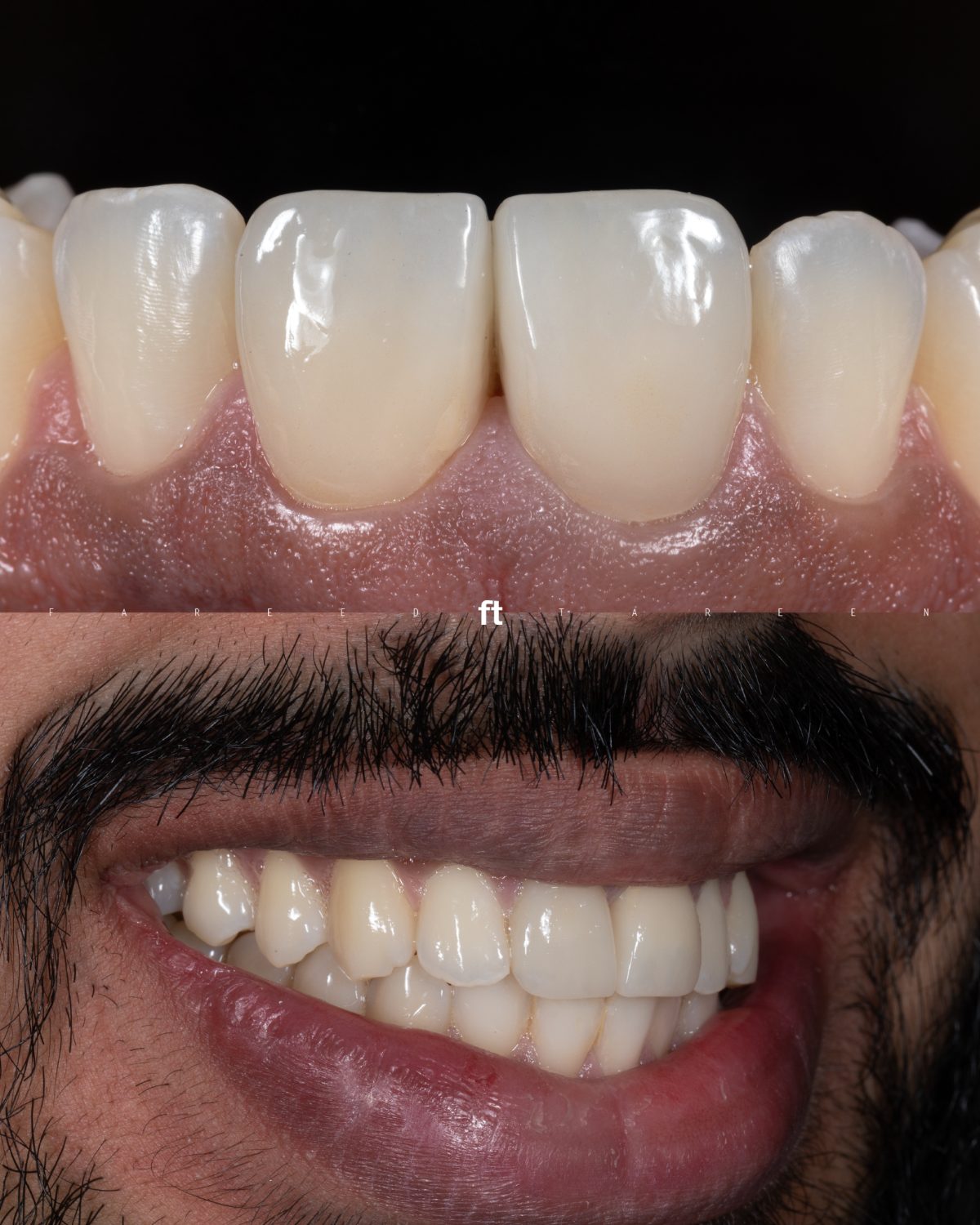 In-house milled, stained and glazed lithium disilicate crowns