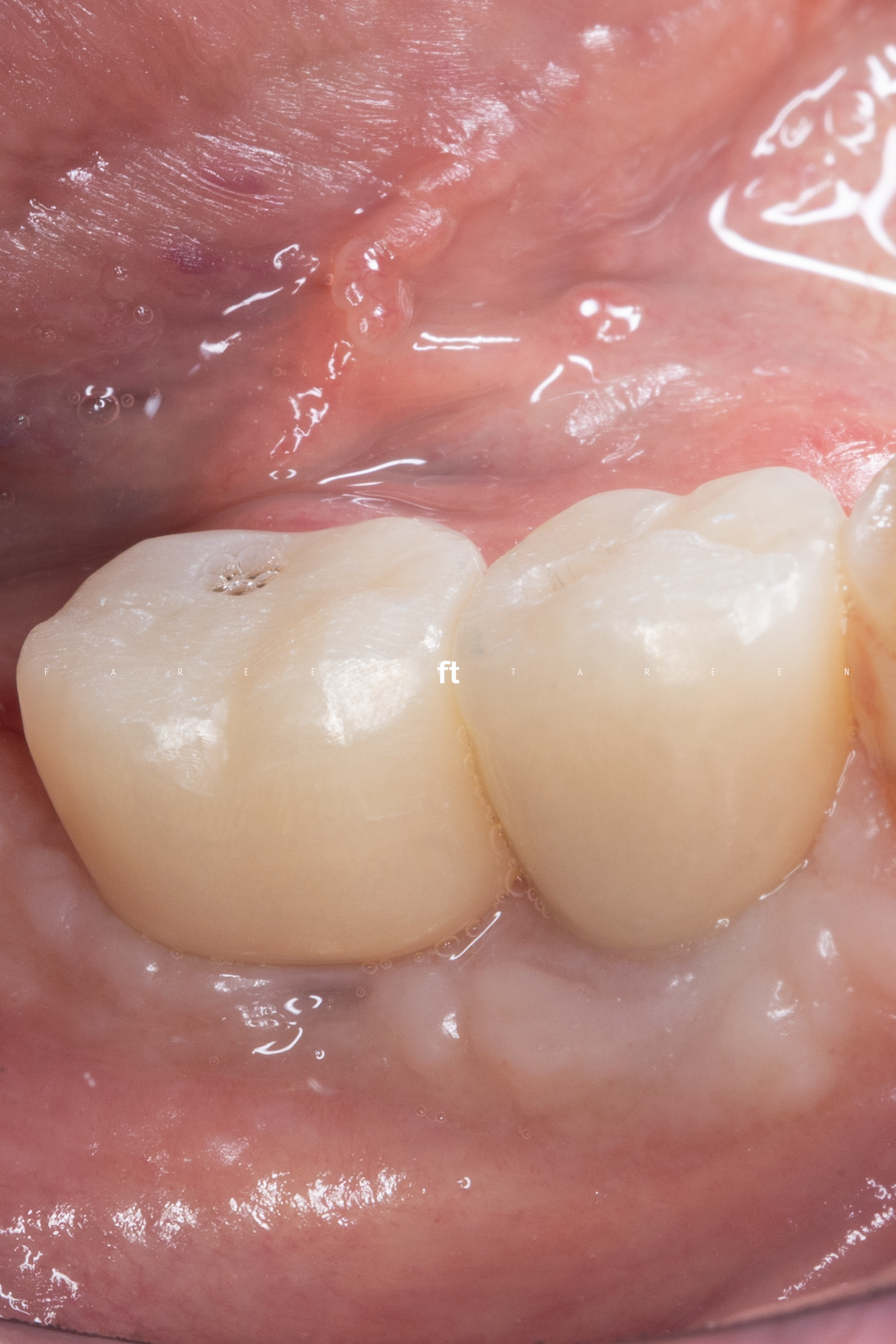 Guided bone regeneration and implant placement — final restorations over a regenerated ridge