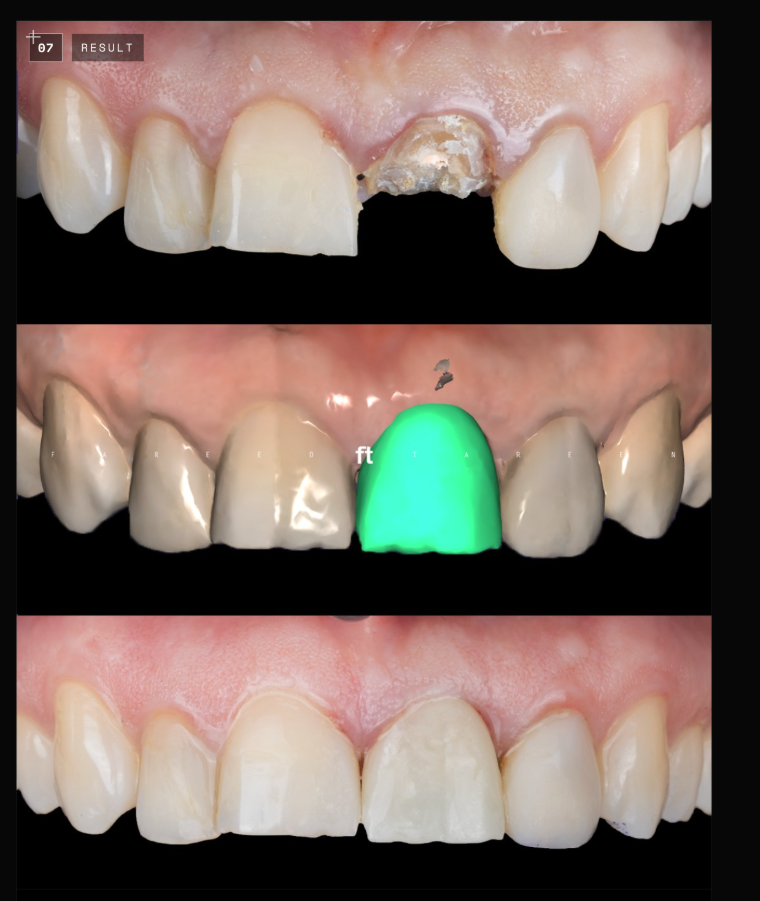 Immediate implant — maxillary central incisor