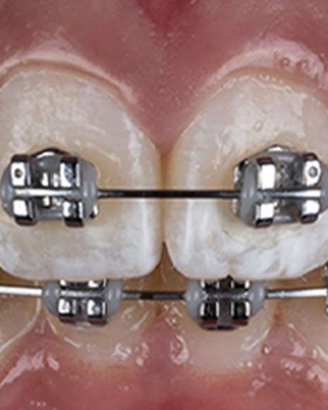 Fixed orthodontic appliance — anterior crowding