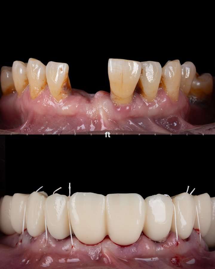 Mandibular & Maxillary FP1 Immediate Load