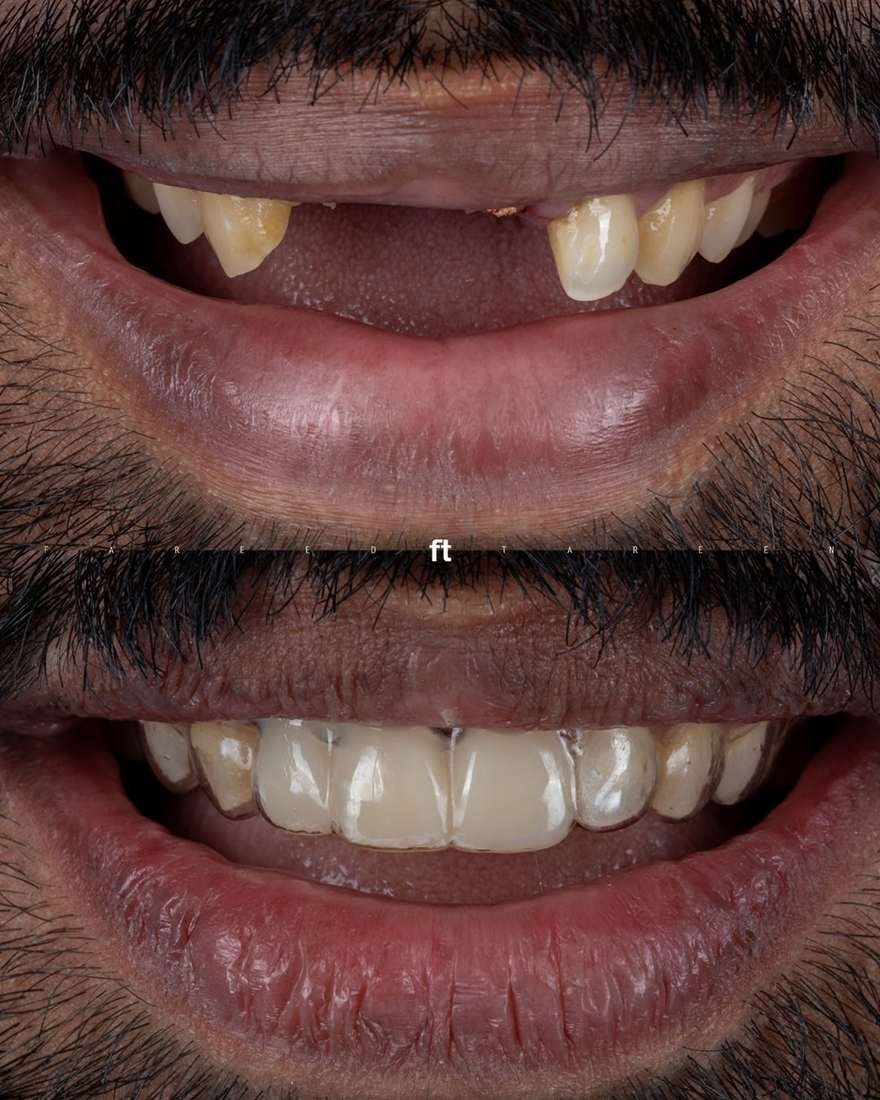 Anterior maxilla immediate implants — before and after
