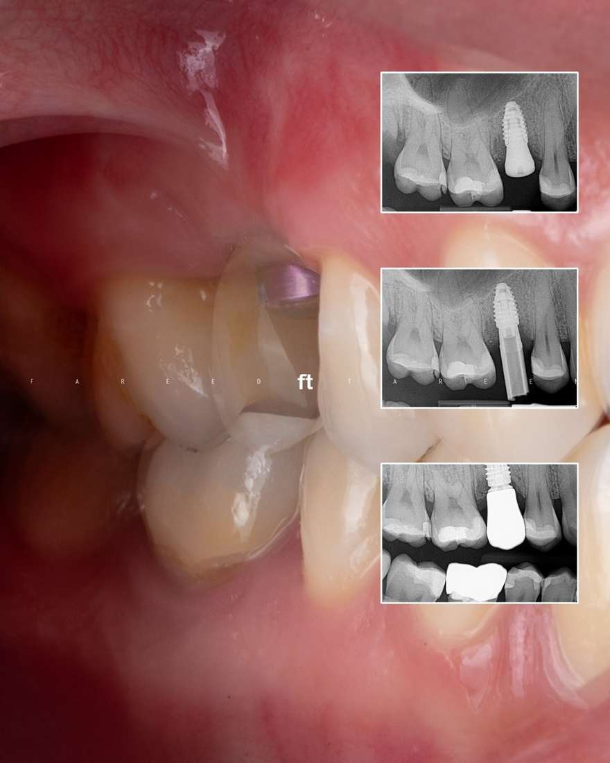 Single posterior implant — radiographic timeline, placement to seated