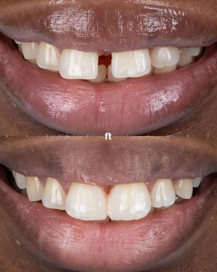 Midline Diastema Composite Closure