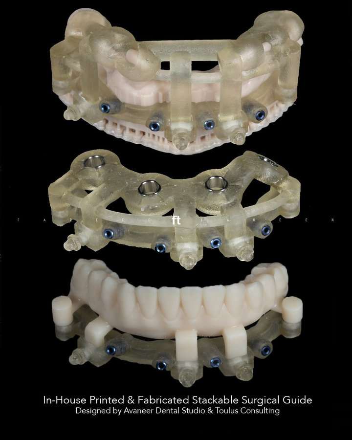 Stackable Surgical Guide